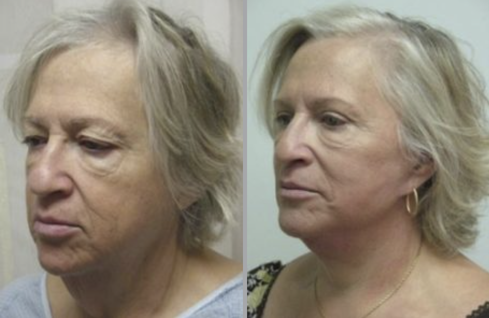 Facelift in Ventura, CA